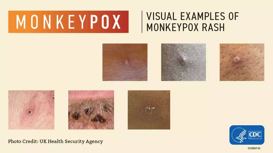 What a Monkeypox rash looks like